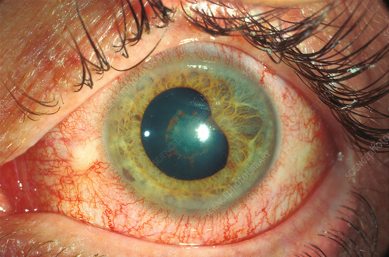 acute-anterior-uveitis-sciencephotolibrary.jpg