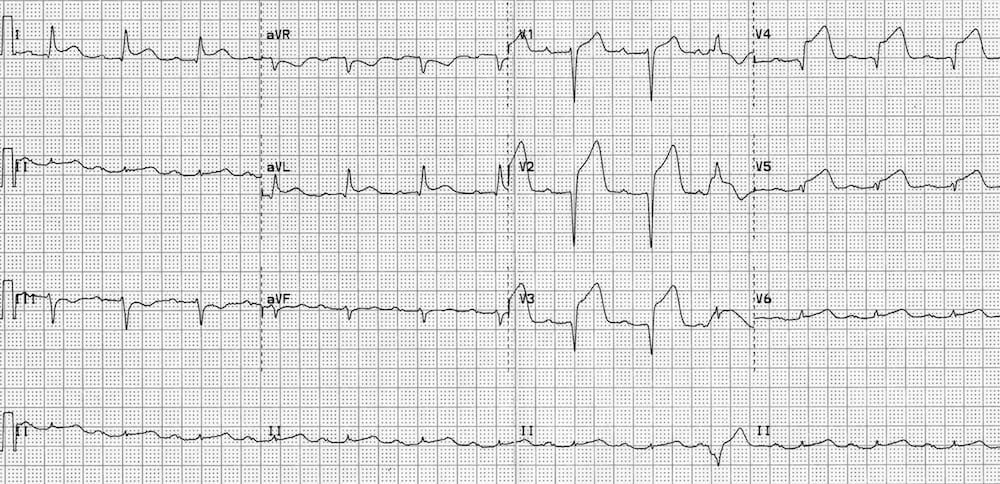 ECG-Anterior-STEMI-evolving.jpg