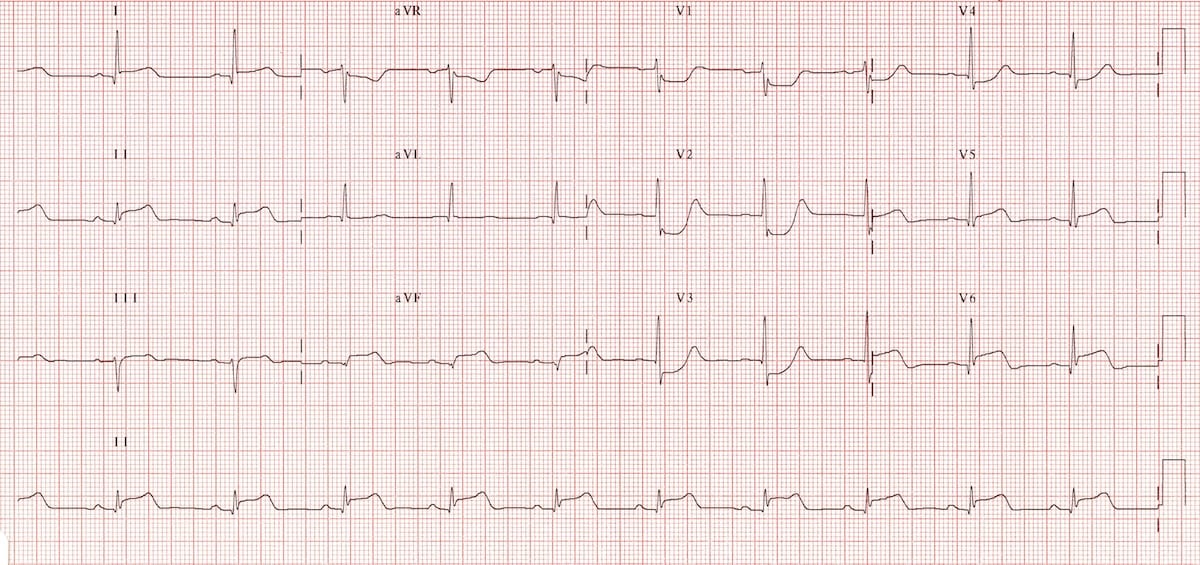 ECG-Posterior-AMI-1.jpg