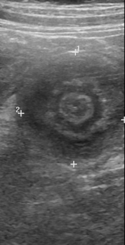 intussusception-uss.jpg