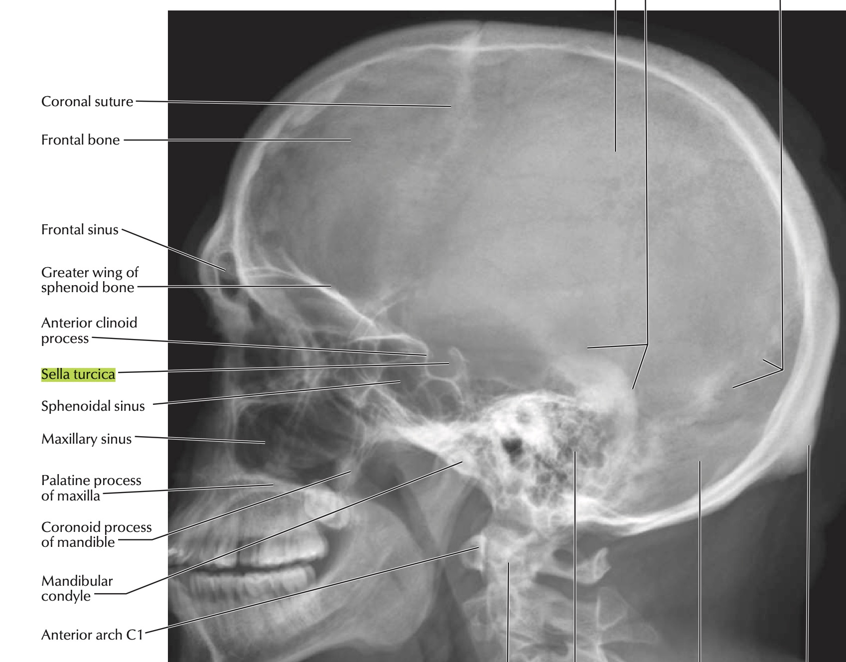 lateral skull xr netter.jpg