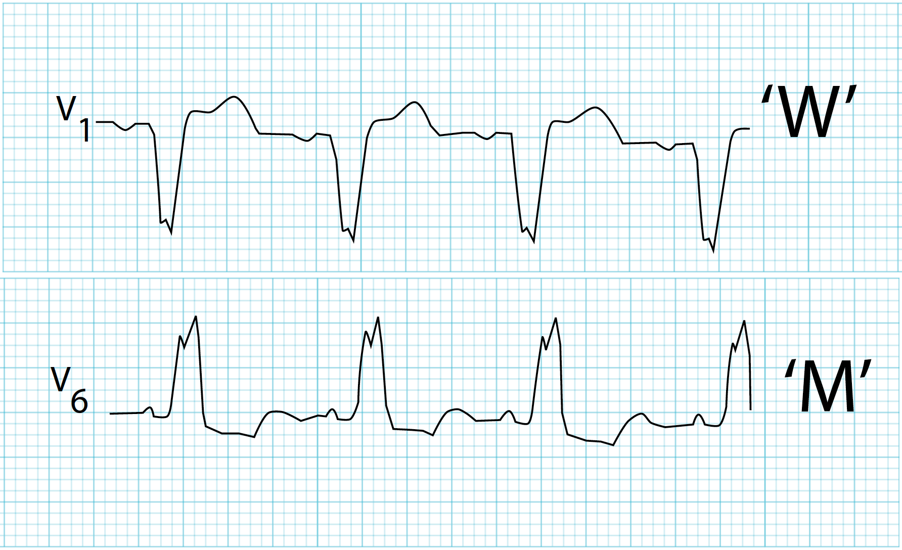 Left-Bundle-Branch-Block-LBBB-ECG-Strip-LITFL.png
