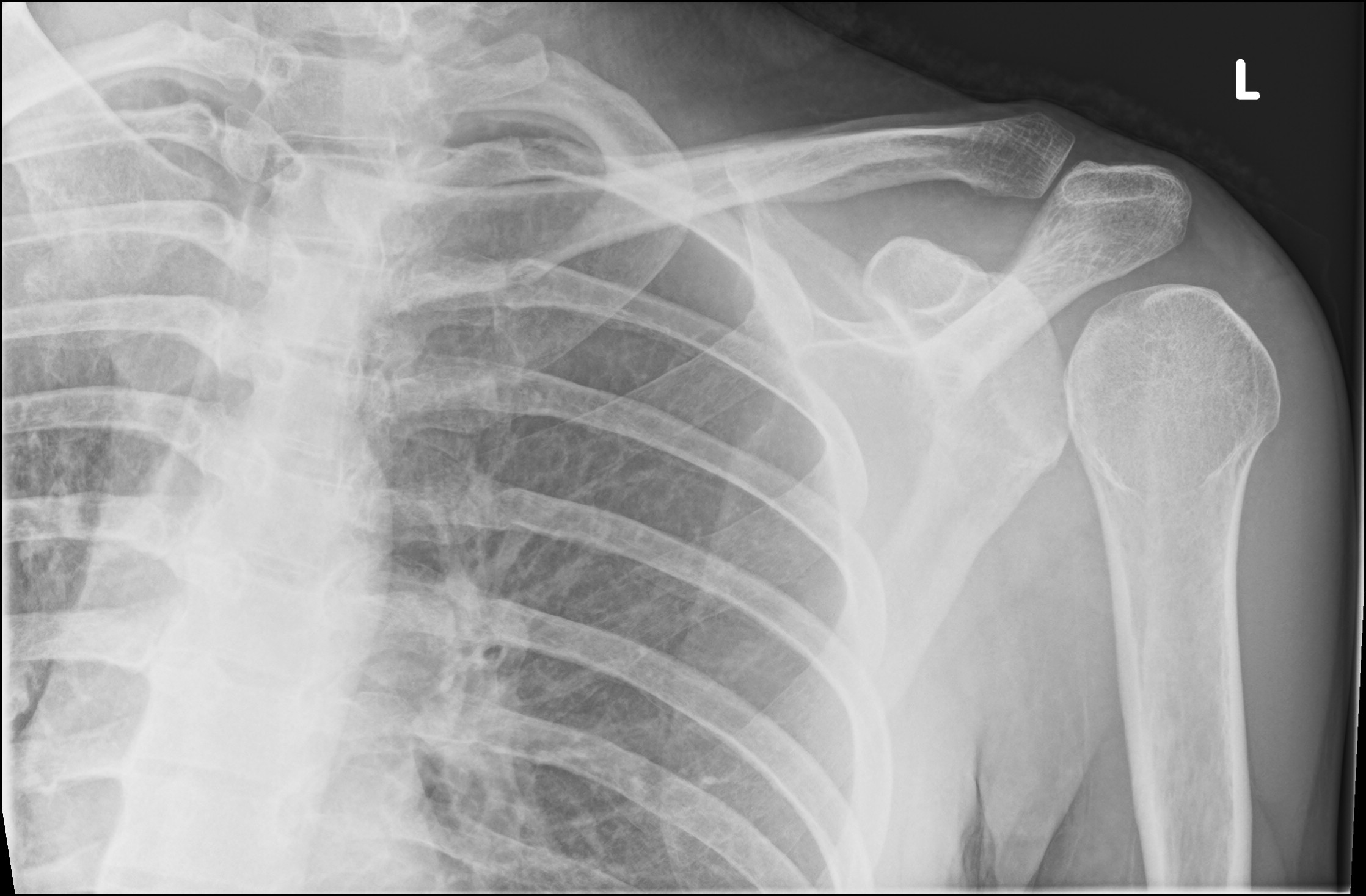 posterior-shoulder-dislocation-28.jpg