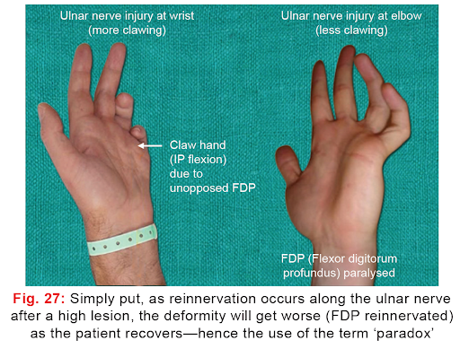 Ulnar-nerve-injury-at-wrist-causes-More-clawing-2.png