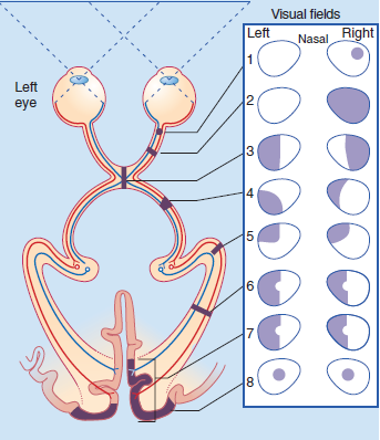 visual field defects grays-8th.png